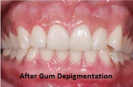 Gingival Correction After