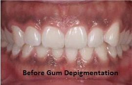 Gingival Correction Before