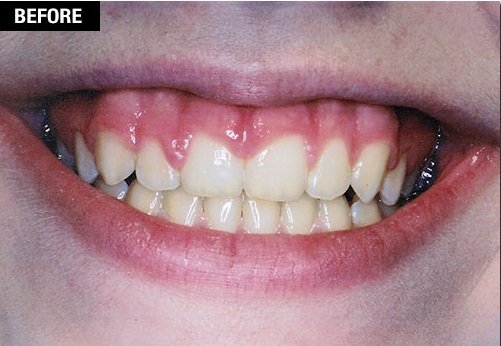 Gum Depigmentation Before