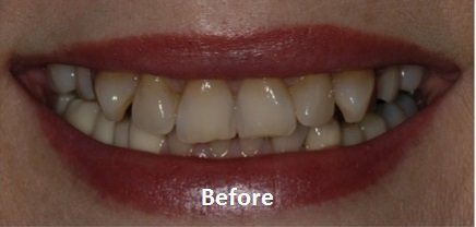 Teeth Alignment Before
